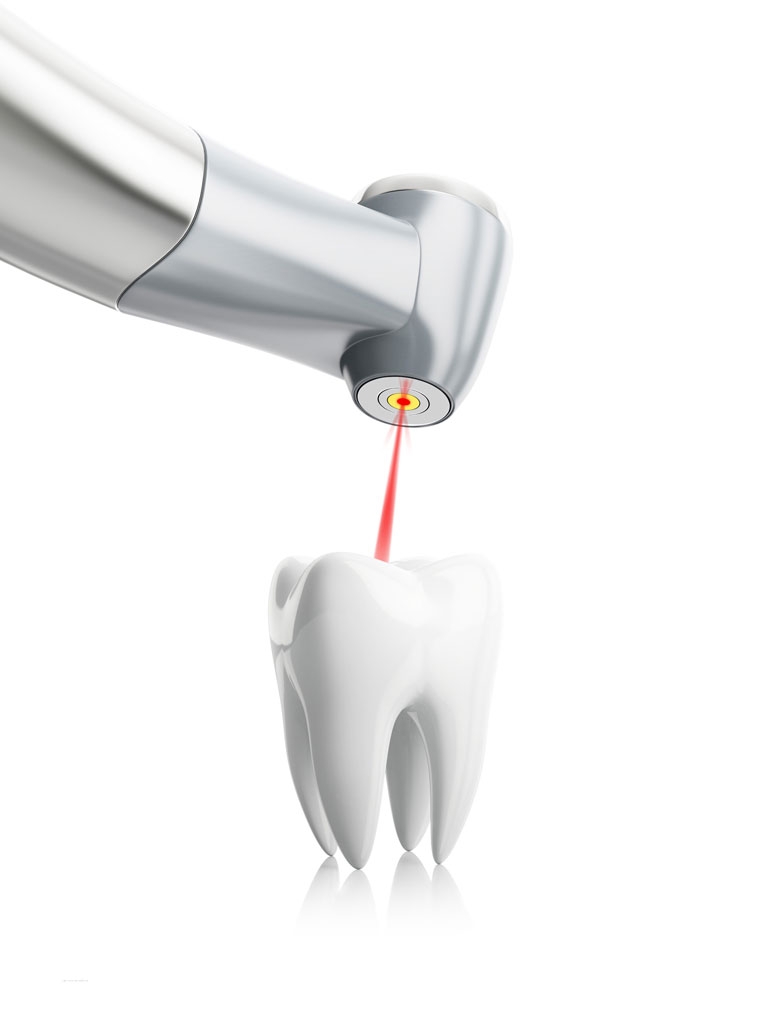 Laserbehandlung Zahn